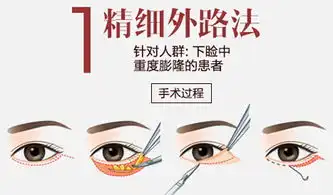 商丘爱艺星整形医院去眼袋怎么样
