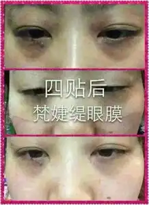 想做去除黑眼圈和眼袋手术不知道效果怎么样安全吗

