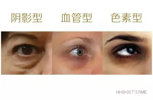 关于黑眼圈你值得知道的事
