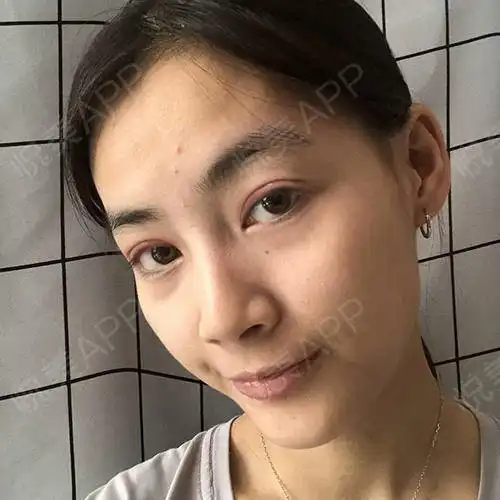 哈哈哈哈,今天去拆线,有点紧张,感觉自己又要上手术...眼综合整形悦美整形
