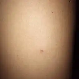 自从养了猫之后,没多久身上就长了好多红色的包,很痒,抓了就变的很严重,十几个地方
