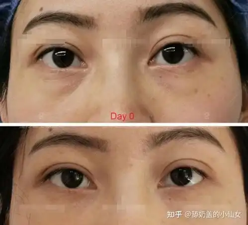 请问,想在广州做去眼袋的手术,哪一家医院会好一点呢一般都多少钱
