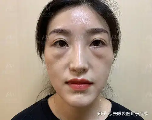 你们对长期熬夜导致的眼部问题有什么眼霜之类的推荐啊
