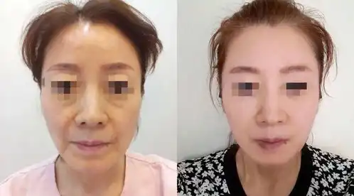 手术除皱
