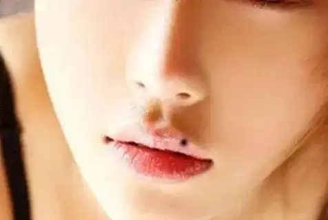 身上的痣要不要去除专业回答
