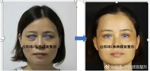 李宇教授华西口腔牙颌面专家团队眼袋祛除术,面部年轻化...转载

