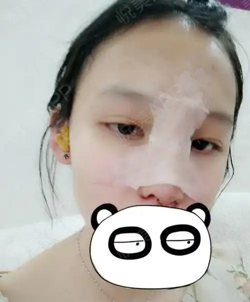 术后第二天,今天去医院去...鼻综合悦美整形
