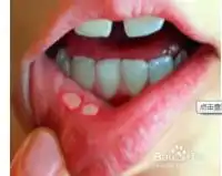 得了口腔溃疡很难受怎么办
