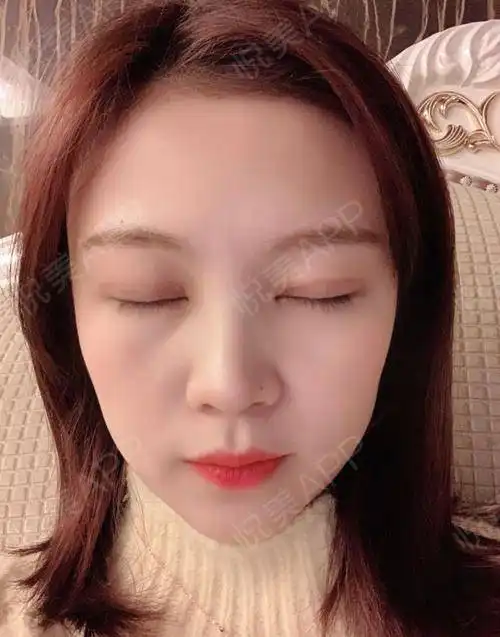 我做手术的时候我是一个人去的医院,当时也超级紧张,...眼部多项悦美整形
