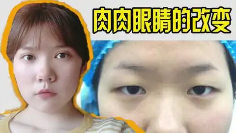 姑娘肉眼泡内眦赘皮明显双眼皮开眼角去皮去脂术后半年恢复过程
