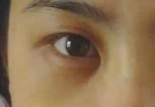 我的黑眼圈一直都很重,每天像被人打过,太烦恼,...去眼袋悦美整形

