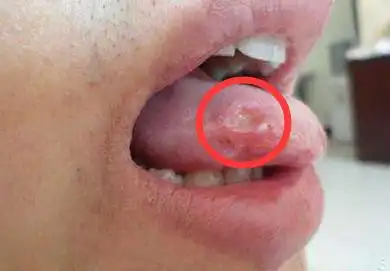 八成口腔溃疡反复的原因,是卫生间的它,医生推崇一个治愈方法
