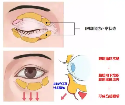 眼袋太重该怎么办不动手术能去除吗手把手教你3招快速轻松摆平眼袋,给显老眼部减龄
