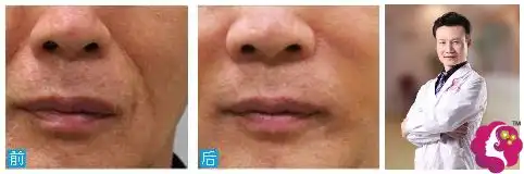 表情玻尿酸祛法令纹效果自然吗苏州维多利亚推荐哪位医生做玻尿酸...表情
