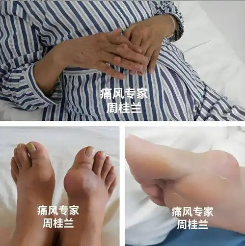 为何痛风石生长位置各不相同四种原因,痛风专家周桂兰科普
