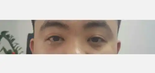 30多岁如何进行眼部护理
