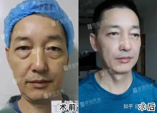 怎样除去眼袋怎么去眼袋和眼纹
