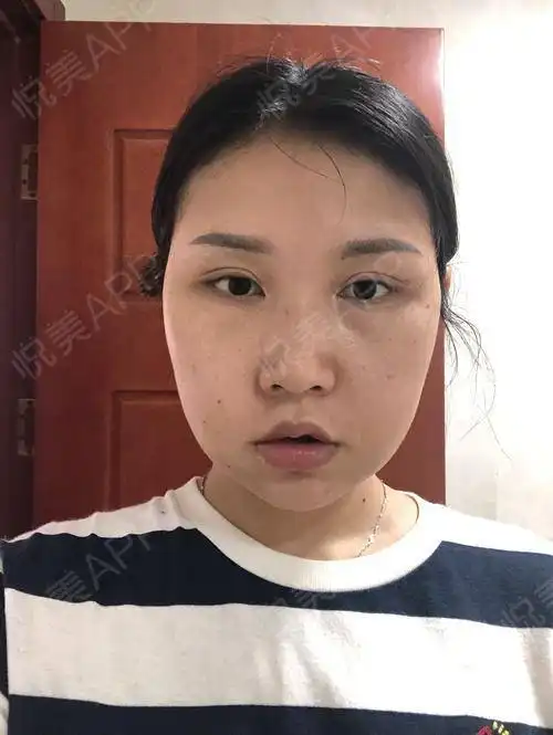 今天是手术后的第7天,该去医院复查换药了,这几天一...颧骨颧弓整形悦美整形
