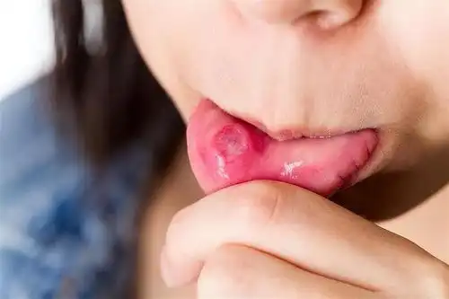有一种痛叫口腔溃疡,补充维c不管用中医用这个方法更靠谱
