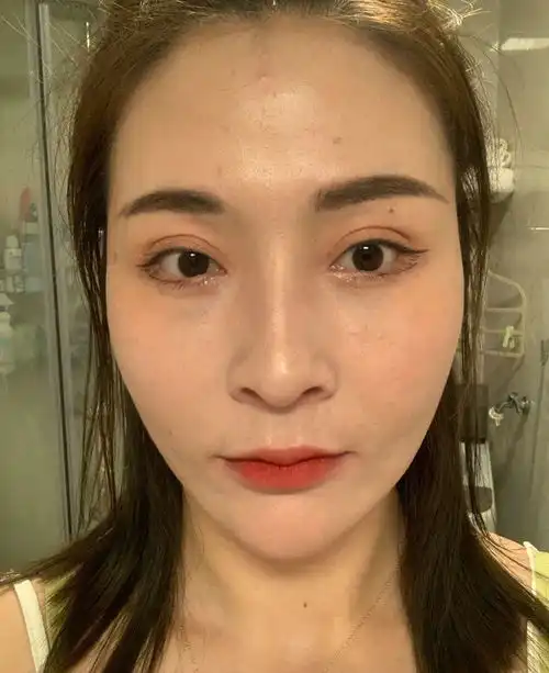 小拉皮术后2个月,跟大家分享一下不同时期疤痕恢复的情况
