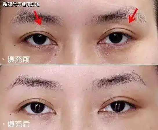 威海整形荣成睿辰医美整形原孙漫整形神态显老的多眼皮眼窝凹陷怎么破
