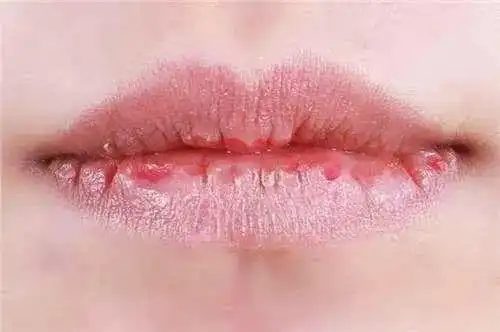 表情让你远离撕裂的痛8个天然护唇法腾讯新闻表情
