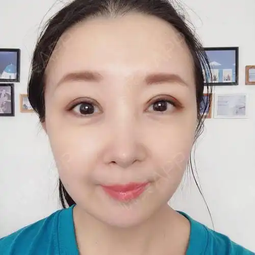 盼来盼去双眼皮手术过了一个月了,之前忌口,好多美味...双眼皮悦美整形
