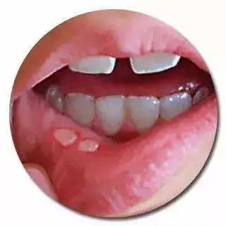 口腔溃疡让您苦不堪言,这1糖1水就能轻松解决问题

