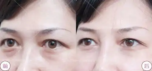 过大年每晚超过12点睡觉,会不会长眼袋
