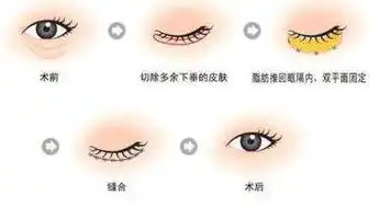 去眼袋方法那么多你了解几种
