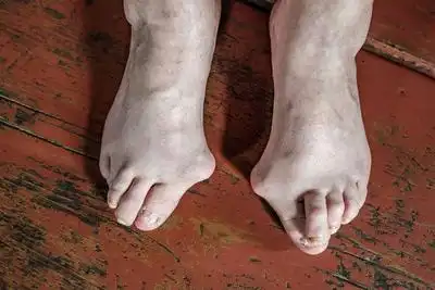 拇囊炎与拇外翻的区别有哪些
