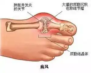 科学饮食,远离痛风
