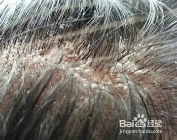 表情头皮屑脂溢性皮炎怎么治表情
