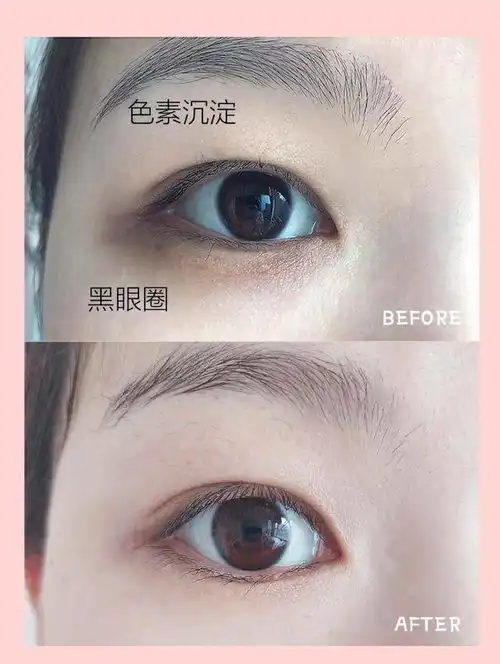 告诉你眼霜怎么选让你15天消除黑眼圈,30天告别眼袋
