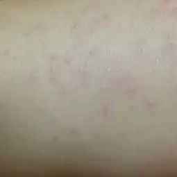 身上起了很多和皮肤一样颜色的小疹子,很痒
